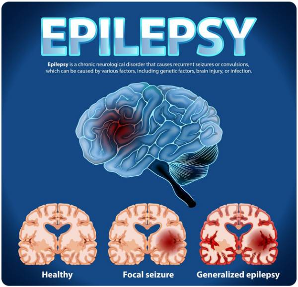Epilepsy Surgery in Haryana