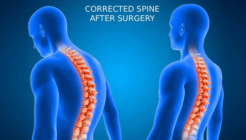 Minimally Invasive Spine Doctor In Haryana