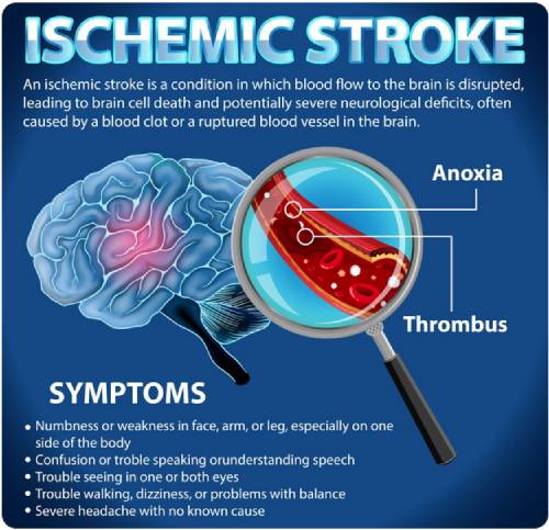 Brain Stroke Specialist In Haryana