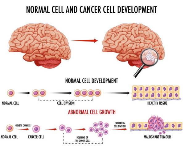 Brain Tumor Clinic In Narnaul
