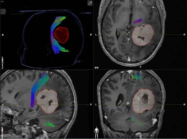 Brain Tumor Surgery In Haryana