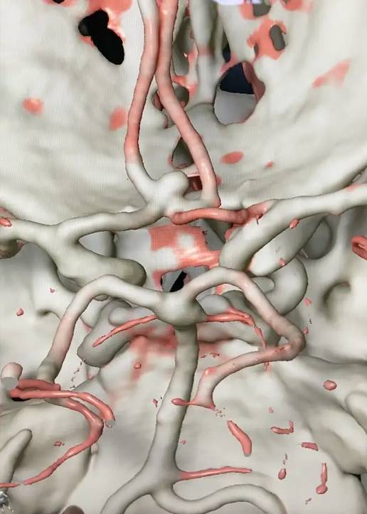 Brain Aneurysm Doctor In Narnaul