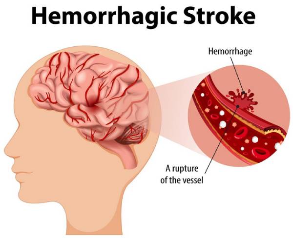 Brain Hemorrhage Surgeon In Haryana