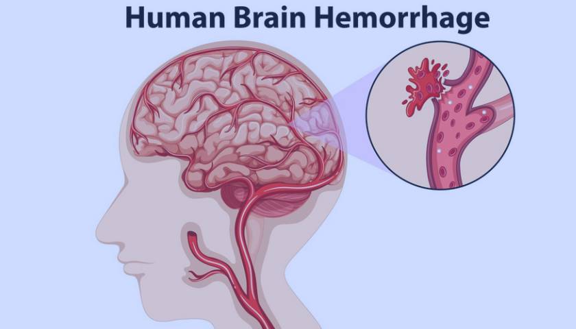 Brain Hemorrhage Treatment In Haryana