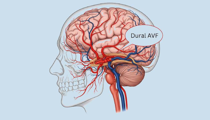 Arteriovenous Fistula Treatment in Narnaul